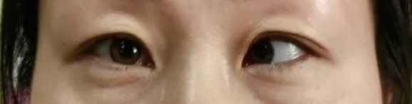 后天形成的鉆石眼如何治療：后天性白內障的治療方法