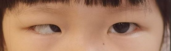 后天形成的鉆石眼如何治療：后天性白內障的治療方法