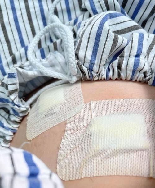 爛尾手術后如何預防感染？（南陽醫專一附院闌尾炎手術后的護理）