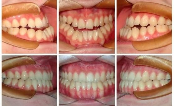 非手術(shù)矯正多久見效（牙齒矯正多久能看到效果） 非手術(shù)矯正多久見效（牙齒矯正多久能看到效果） 龍魚百科 第5張