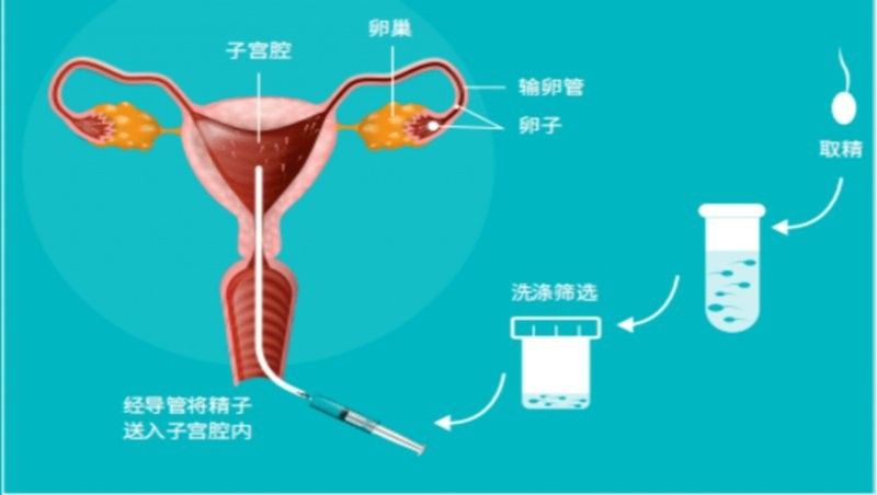 人工授精的成功率有多高？（人工授精的成功率因個體差異而異，值得注意的是它）