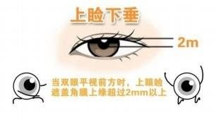 吊眼手術風險大嗎？（副主任醫師三甲外切眼袋手術有哪些風險）