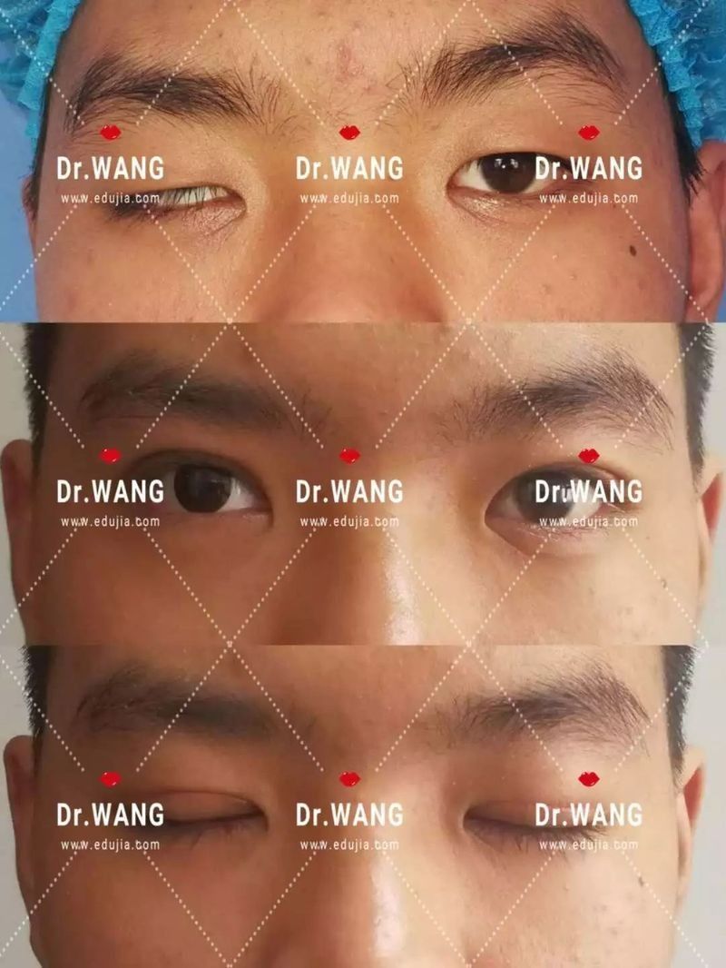 吊眼手術風險大嗎？（副主任醫師三甲外切眼袋手術有哪些風險）