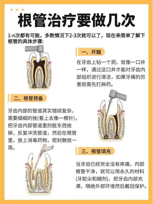 根管治療期間如何保持口腔衛生（李祥副主任醫師三甲根管治療期間飲食注意事項有哪些）