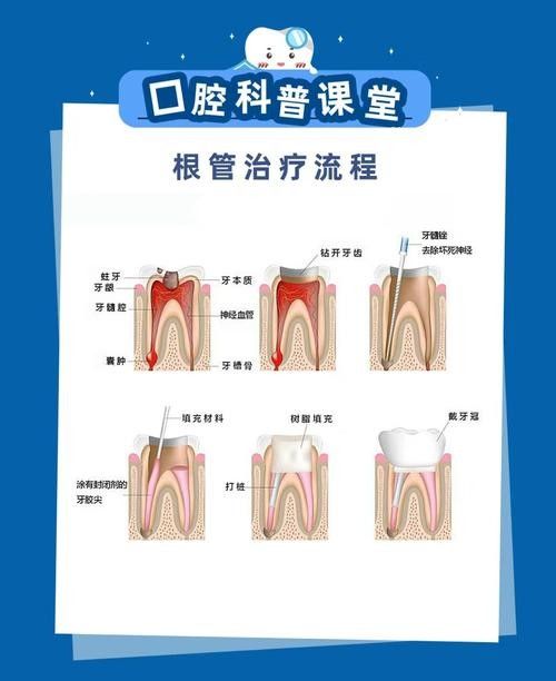 根管治療期間如何保持口腔衛生（李祥副主任醫師三甲根管治療期間飲食注意事項有哪些）