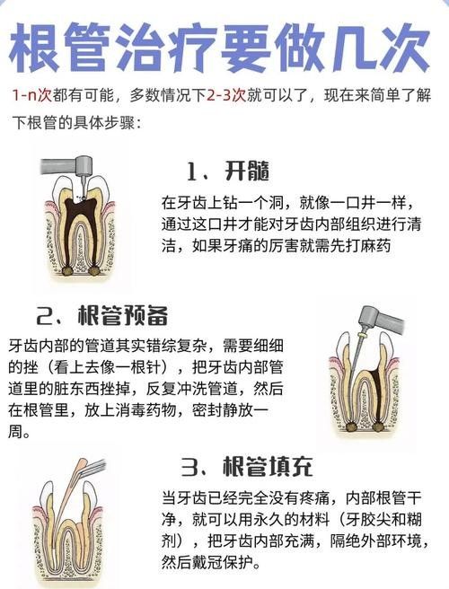 根管治療期間如何保持口腔衛生（李祥副主任醫師三甲根管治療期間飲食注意事項有哪些）