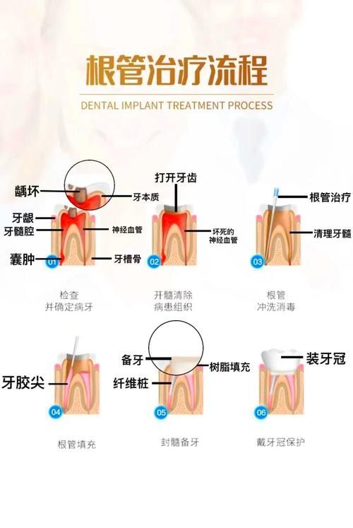 根管治療期間如何保持口腔衛生（李祥副主任醫師三甲根管治療期間飲食注意事項有哪些）