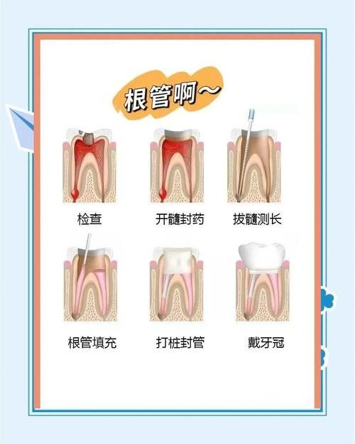 根管治療期間如何保持口腔衛生（李祥副主任醫師三甲根管治療期間飲食注意事項有哪些）