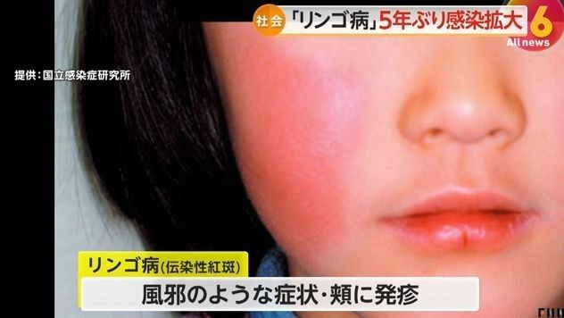 紅點病有哪些癥狀？（紅點病的癥狀具體表現(xiàn)是什么劉愛華主任醫(yī)師三甲聽）
