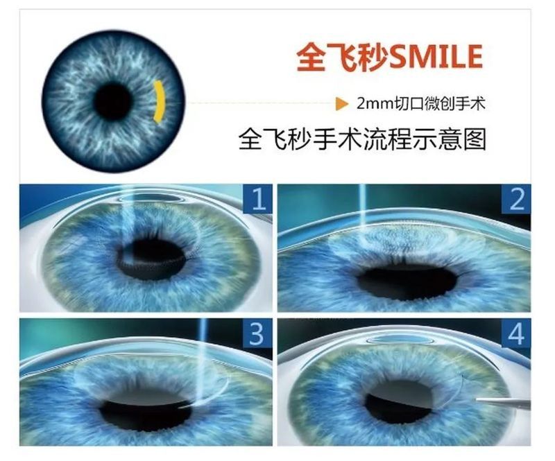 哪些醫院擅長金龍魚手術？（北京哪家醫院做近視手術最好） 哪些醫院擅長金龍魚手術？（北京哪家醫院做近視手術最好） 龍魚百科 第7張