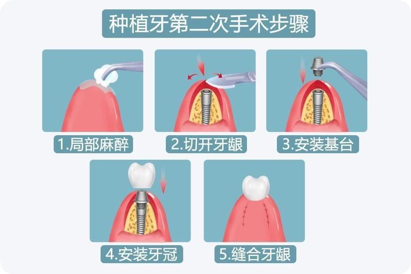 二次手術后如何護理（二次手術后的護理） 二次手術后如何護理（二次手術后的護理） 龍魚百科 第4張