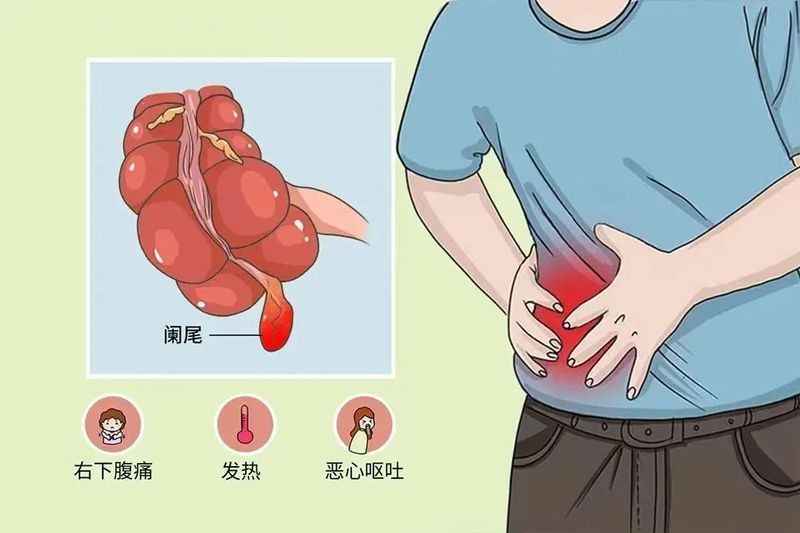 如何判斷闌尾炎是否復發？（「當心」身體出現5種情況，當心闌尾炎!）