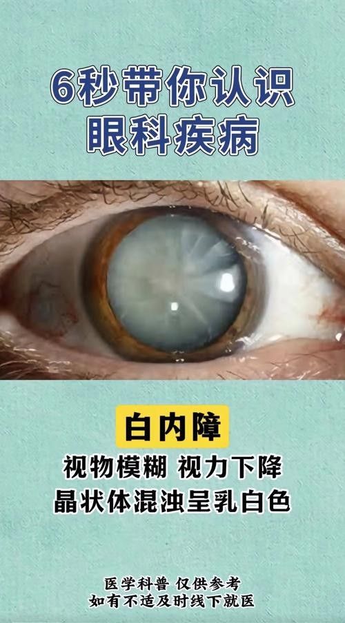 如何判斷鉆石眼是否嚴重？（判斷鉆石眼是否嚴重需要綜合考慮多個因素，眼科醫生綜合評估） 如何判斷鉆石眼是否嚴重？（判斷鉆石眼是否嚴重需要綜合考慮多個因素，眼科醫生綜合評估） 龍魚百科 第4張