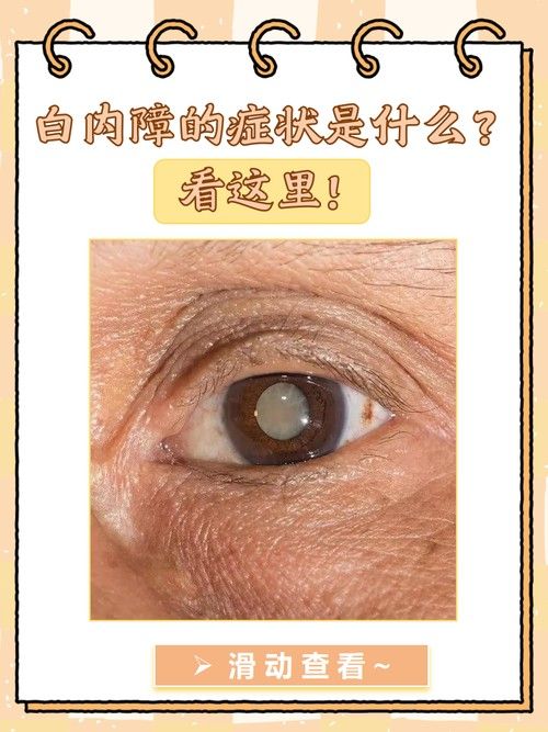 如何判斷鉆石眼是否嚴重？（判斷鉆石眼是否嚴重需要綜合考慮多個因素，眼科醫生綜合評估） 如何判斷鉆石眼是否嚴重？（判斷鉆石眼是否嚴重需要綜合考慮多個因素，眼科醫生綜合評估） 龍魚百科 第5張