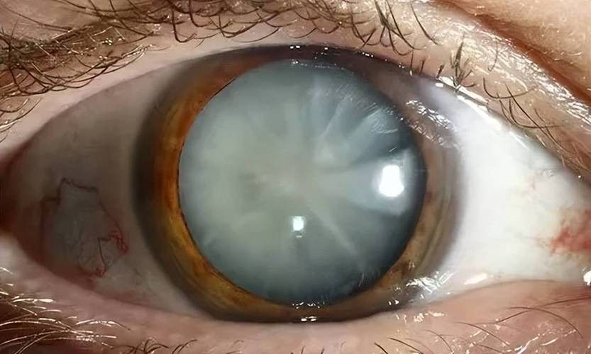 如何判斷鉆石眼是否嚴重？（判斷鉆石眼是否嚴重需要綜合考慮多個因素，眼科醫生綜合評估） 如何判斷鉆石眼是否嚴重？（判斷鉆石眼是否嚴重需要綜合考慮多個因素，眼科醫生綜合評估） 龍魚百科 第1張
