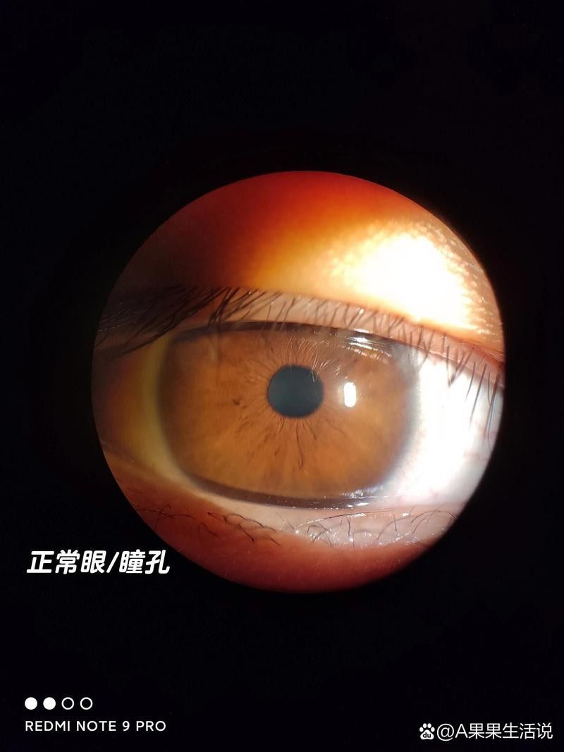如何判斷鉆石眼是否嚴重？（判斷鉆石眼是否嚴重需要綜合考慮多個因素，眼科醫生綜合評估） 如何判斷鉆石眼是否嚴重？（判斷鉆石眼是否嚴重需要綜合考慮多個因素，眼科醫生綜合評估） 龍魚百科 第6張