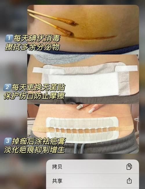 抽腹水后如何預(yù)防感染？