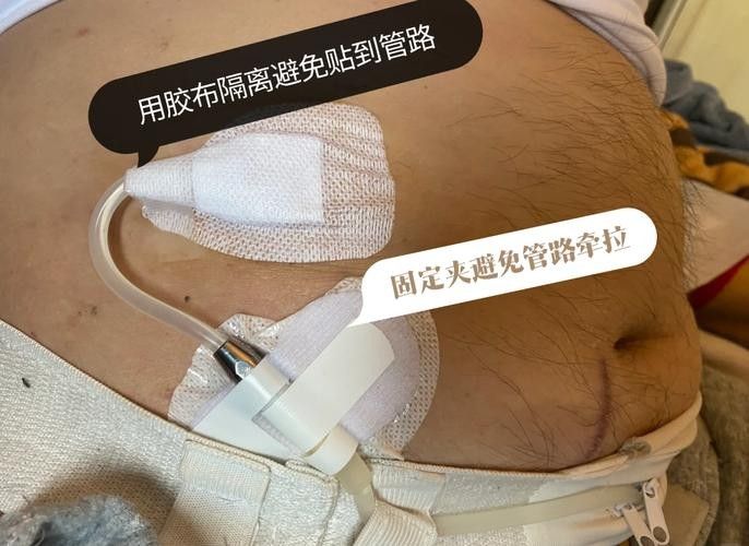 抽腹水后如何預(yù)防感染？