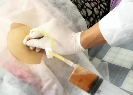 抽腹水后如何預(yù)防感染？
