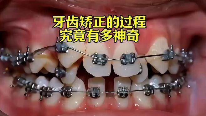 非手術(shù)矯正方法需要多長(zhǎng)時(shí)間見(jiàn)效（牙齒矯正需要多長(zhǎng)時(shí)間） 非手術(shù)矯正方法需要多長(zhǎng)時(shí)間見(jiàn)效（牙齒矯正需要多長(zhǎng)時(shí)間） 龍魚(yú)百科 第2張