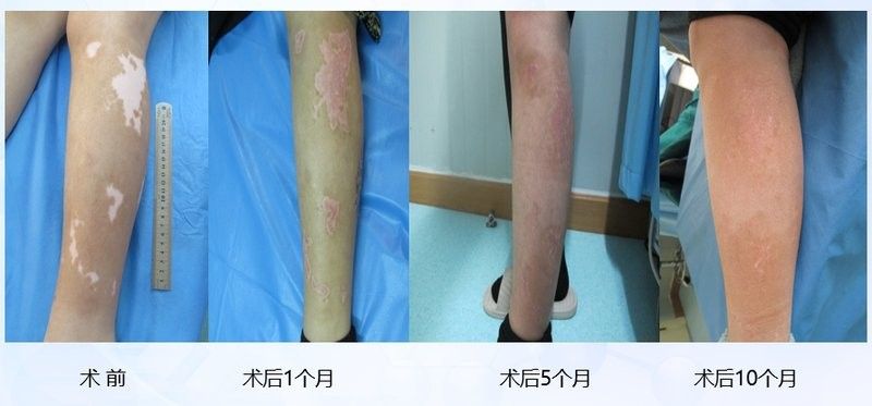 白斑病治療需要多長時間？（南方醫科大學附屬第一醫院【健康科普】治療白癜風） 白斑病治療需要多長時間？（南方醫科大學附屬第一醫院【健康科普】治療白癜風） 龍魚百科 第5張