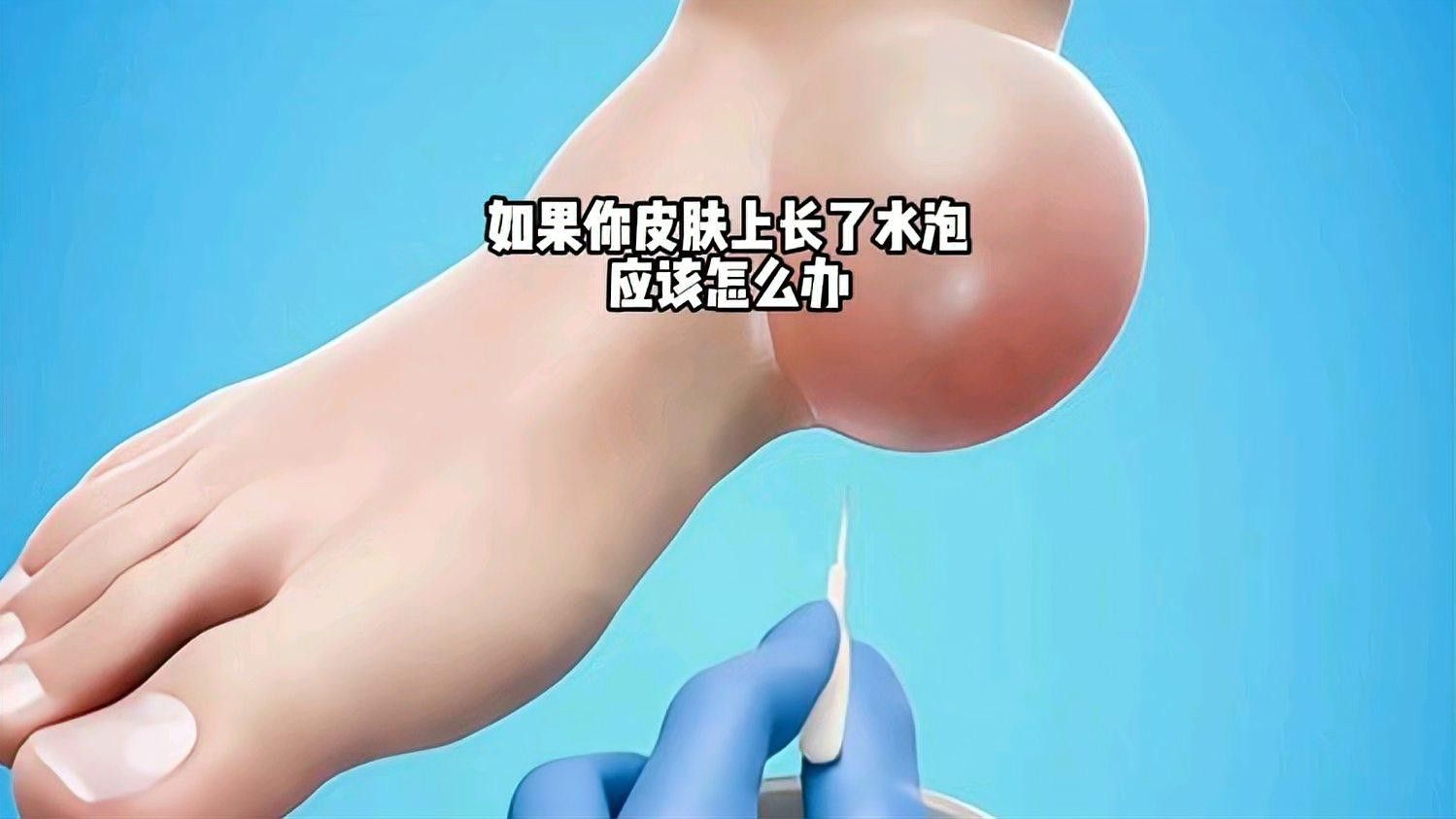 水泡病有哪些治療方法（如果你的皮膚上長(zhǎng)了一個(gè)水泡,應(yīng)該怎么辦）