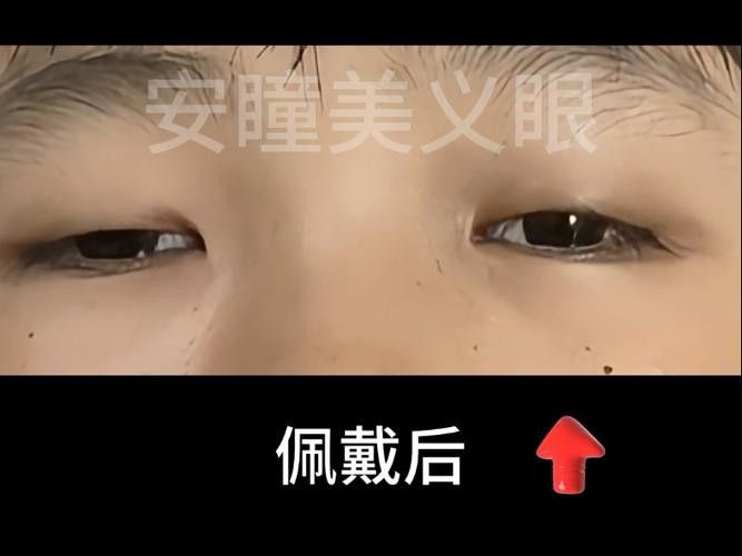 哪種材質(zhì)的義眼最好？