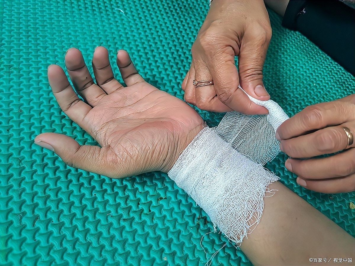 碘伏消毒后需要包扎傷口嗎？（副主任醫師三甲傷口可以涂在傷口上嗎）