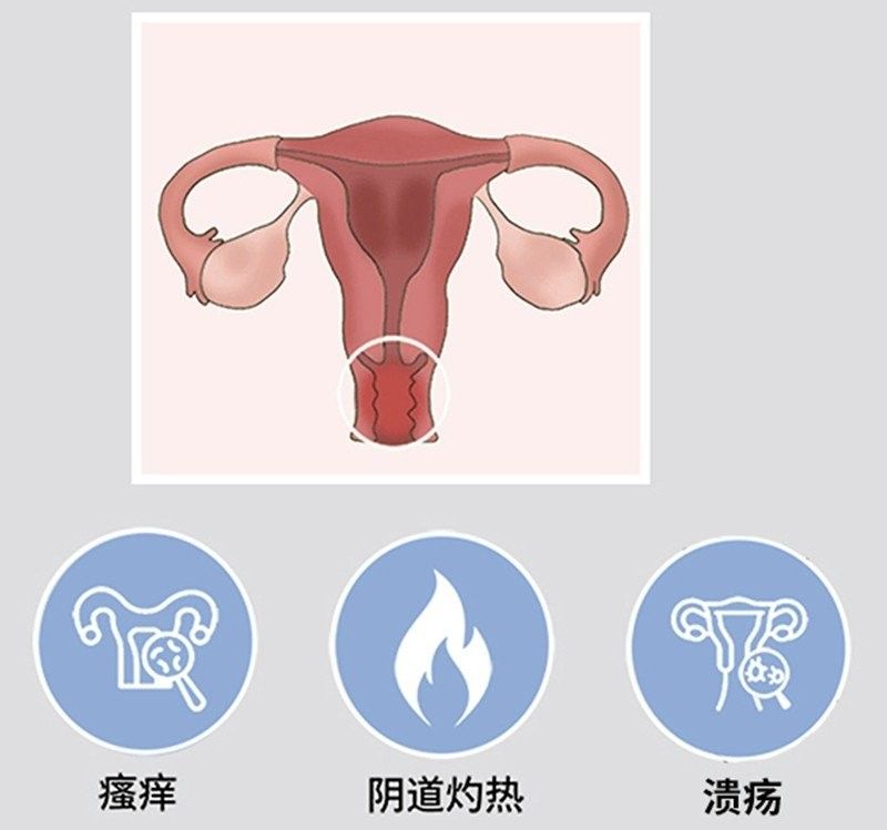 如何預防白霉病的復發（——預防霉菌性陰道炎怎么預防復發）