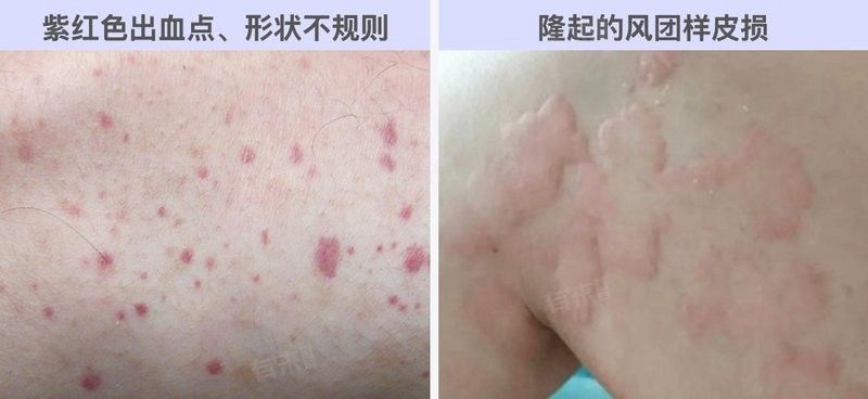 敗血癥癥狀有哪些？（楊柳副主任醫師三甲敗血癥有哪些癥狀有哪些癥狀）