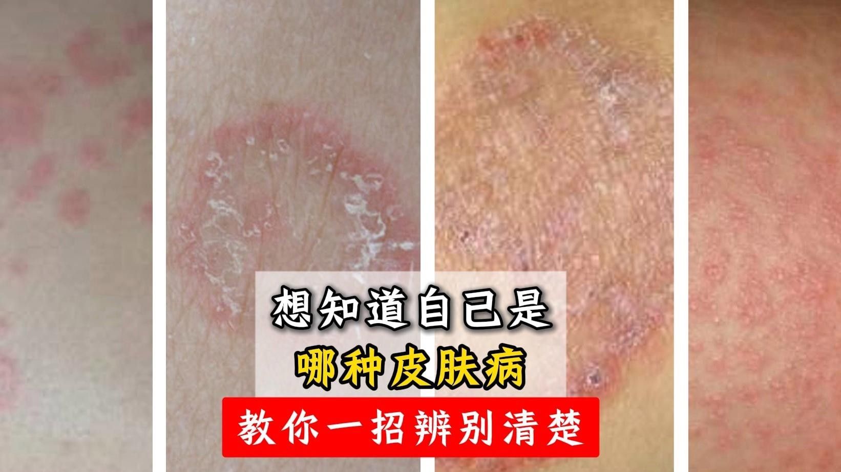 異常脫皮如何處理？