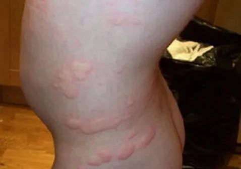 異常脫皮如何處理？