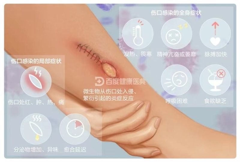 如何判斷傷口是否感染？（傷口是否感染是一個(gè)復(fù)雜的過程）