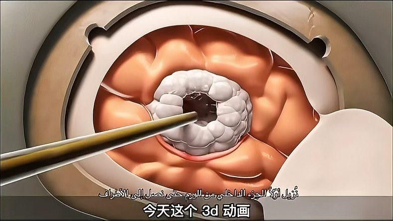 手術成功率高嗎？（|帶你了解開顱手術過程崔醫生講科普）