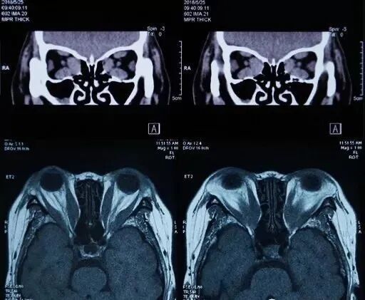 突眼病有哪些癥狀？（三甲甲狀腺突眼患者有什么癥狀）