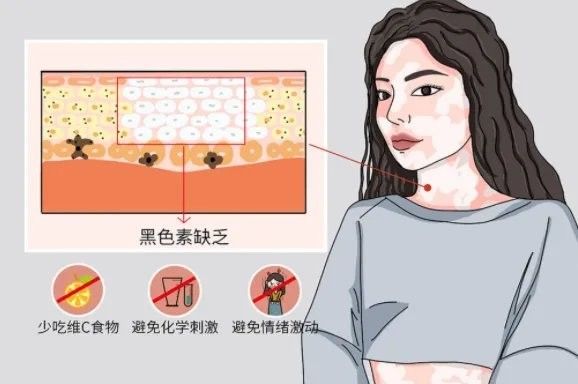 白點病藥物治療后多久見效（白癜風吃藥多久能治愈劉雯敏副主任醫師三甲白斑治療多久見效） 白點病藥物治療后多久見效（白癜風吃藥多久能治愈劉雯敏副主任醫師三甲白斑治療多久見效） 龍魚百科 第5張