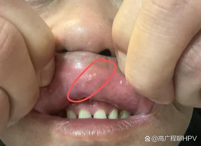 魚嘴有白色米粒狀圖片（魚嘴上出現白色米粒狀物質） 魚嘴有白色米粒狀圖片（魚嘴上出現白色米粒狀物質） 觀賞魚百科 第3張