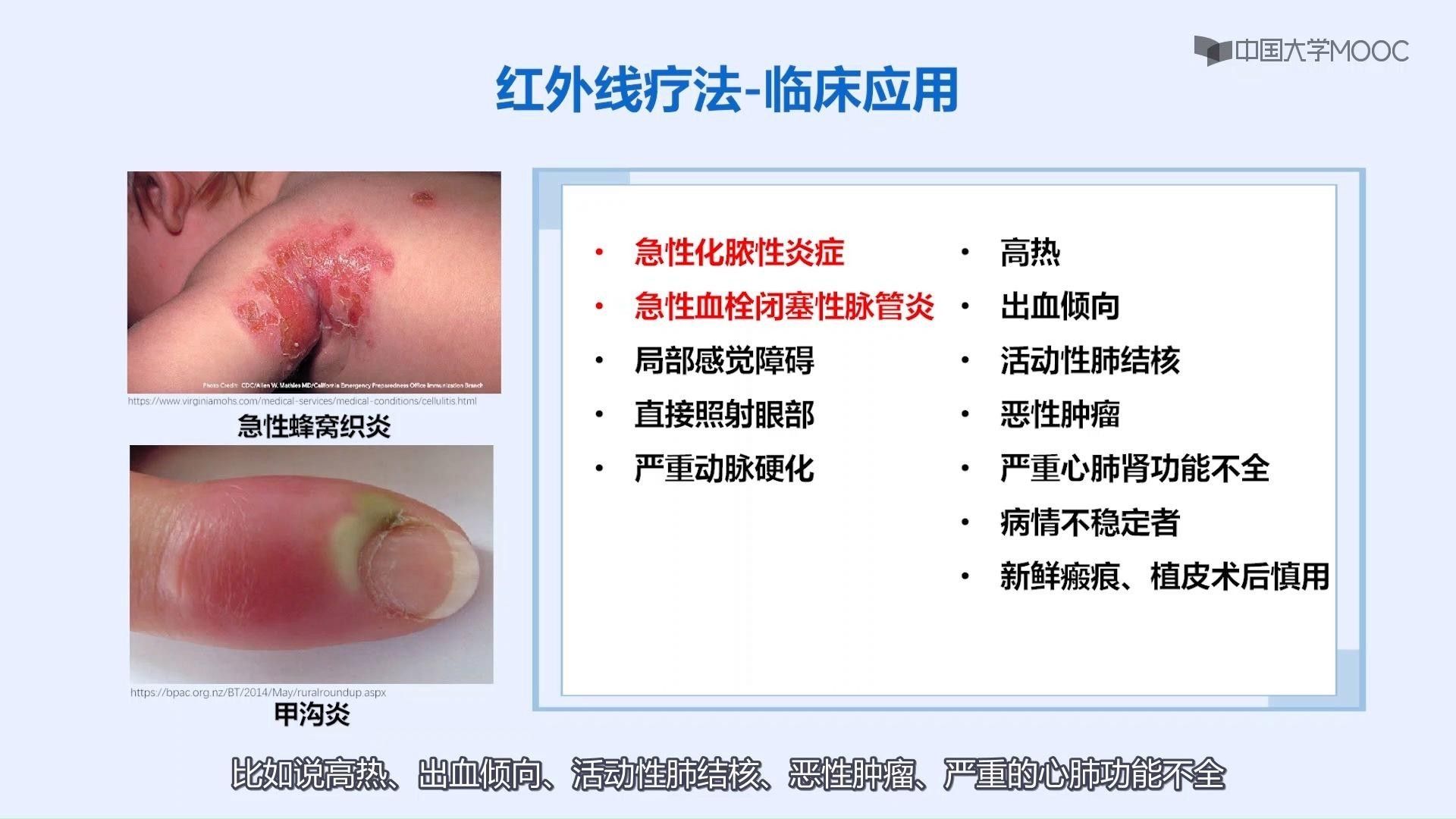 紅外線療法的作用和禁忌癥（南方醫科大學——南方醫科大學紅外線療法注意事項）