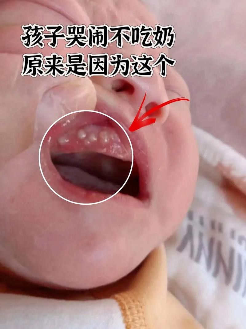 寶寶嘴角內側的肉芽是由多種原因引起的，寶寶嘴角內側出現肉芽狀組織可能涉及多種情況，家長應立即就醫
