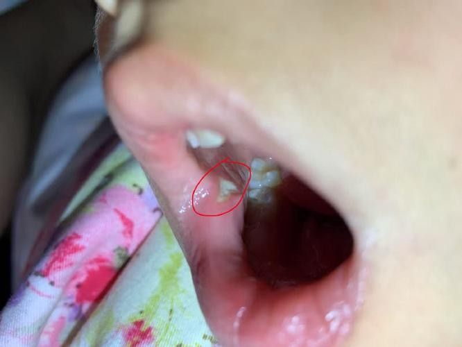 寶寶嘴角內側的肉芽是由多種原因引起的，寶寶嘴角內側出現肉芽狀組織可能涉及多種情況，家長應立即就醫