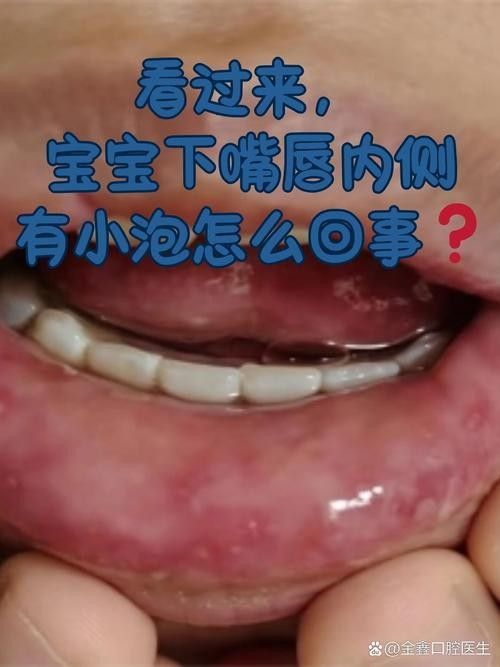 寶寶嘴角內側的肉芽是由多種原因引起的，寶寶嘴角內側出現肉芽狀組織可能涉及多種情況，家長應立即就醫