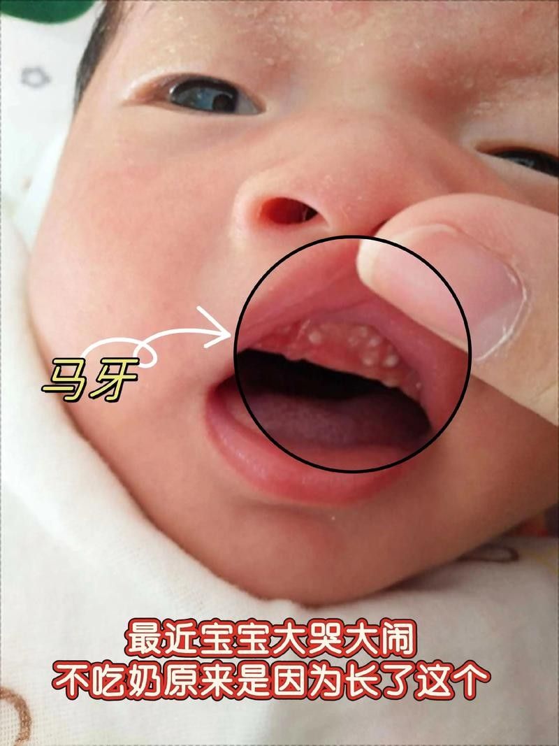 寶寶嘴角內側的肉芽是由多種原因引起的，寶寶嘴角內側出現肉芽狀組織可能涉及多種情況，家長應立即就醫
