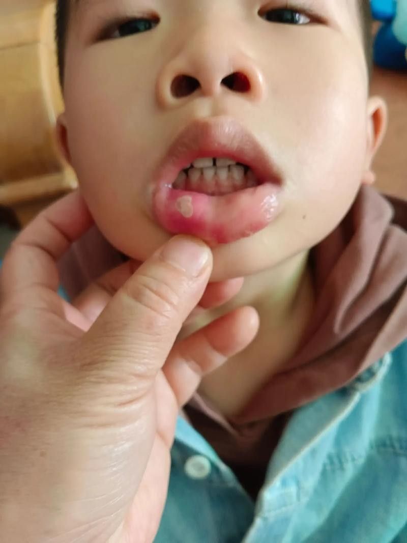寶寶嘴角內側的肉芽是由多種原因引起的，寶寶嘴角內側出現肉芽狀組織可能涉及多種情況，家長應立即就醫