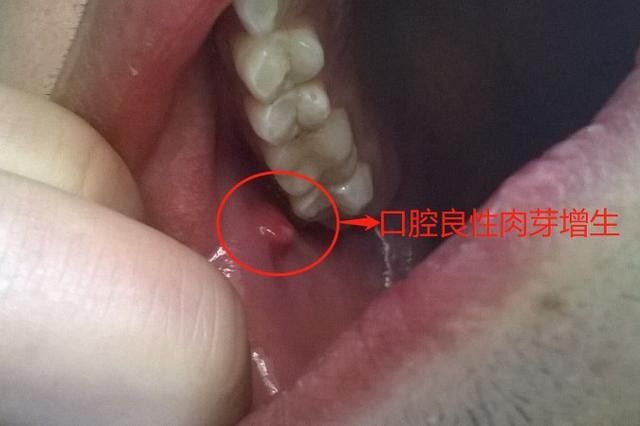 寶寶嘴角內側的肉芽是由多種原因引起的，寶寶嘴角內側出現肉芽狀組織可能涉及多種情況，家長應立即就醫