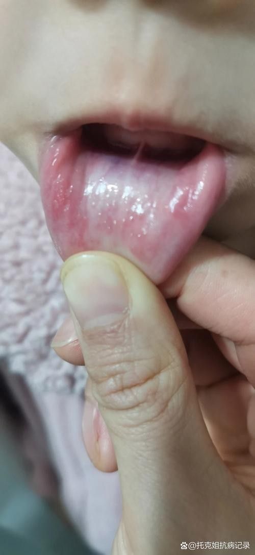 寶寶嘴角內側的肉芽是由多種原因引起的，寶寶嘴角內側出現肉芽狀組織可能涉及多種情況，家長應立即就醫