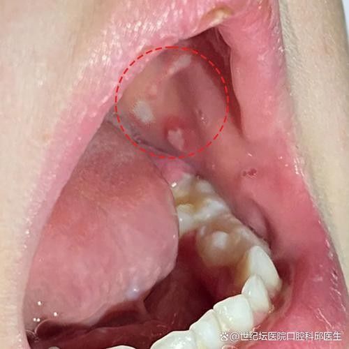 寶寶嘴角內側的肉芽是由多種原因引起的，寶寶嘴角內側出現肉芽狀組織可能涉及多種情況，家長應立即就醫