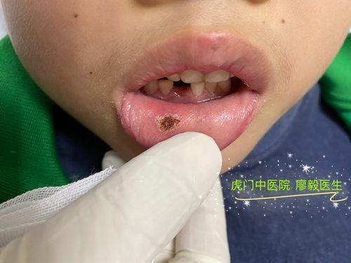 寶寶嘴角內側的肉芽是由多種原因引起的，寶寶嘴角內側出現肉芽狀組織可能涉及多種情況，家長應立即就醫