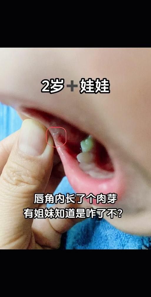 寶寶嘴角內側的肉芽是由多種原因引起的，寶寶嘴角內側出現肉芽狀組織可能涉及多種情況，家長應立即就醫