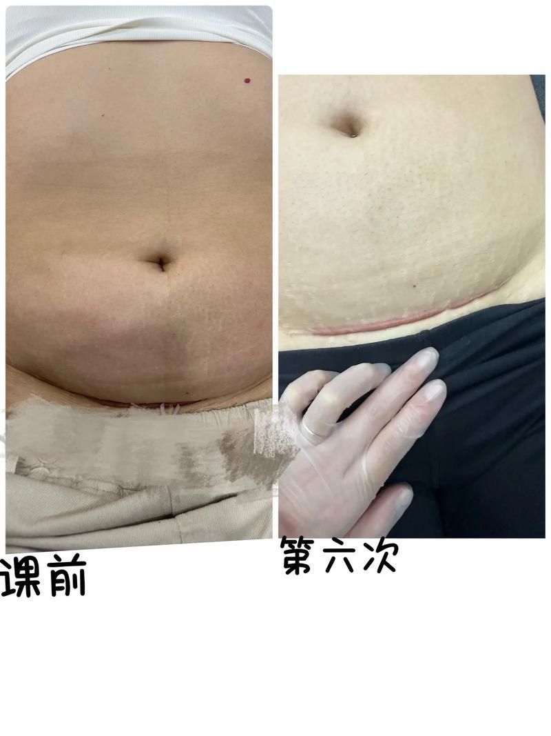 如何判斷龍魚(yú)是否需要手術(shù)治療？（如何判斷龍魚(yú)是否需要手術(shù)治療）