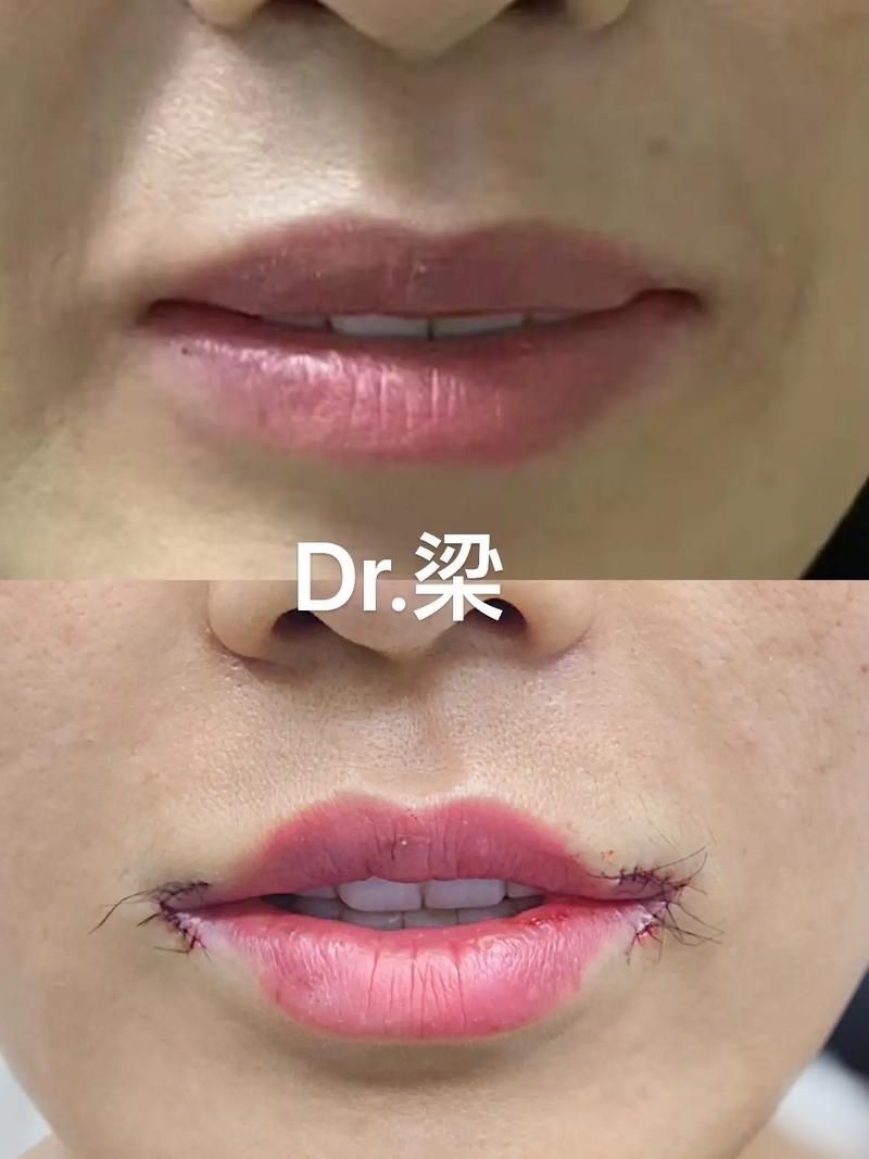 手術矯正龍魚嘴歪需要多長時間恢復？（手術矯正“龍魚嘴歪”并非醫(yī)學術語需召回與手術恢復過程）